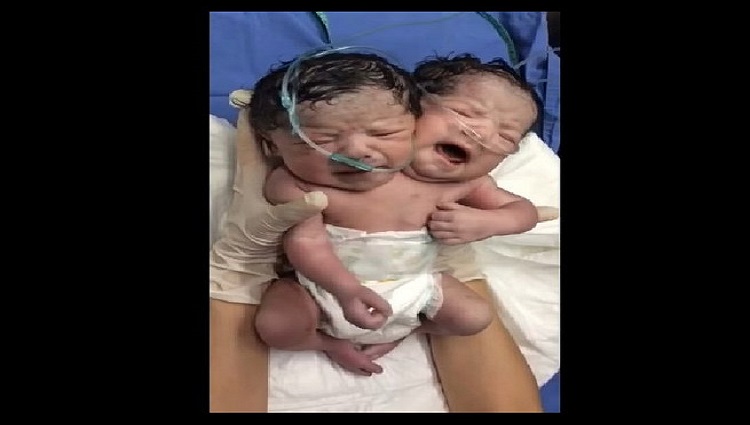 Conjoined Twins with two heads and body