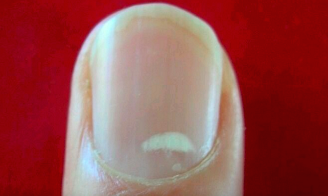 white marks on nails