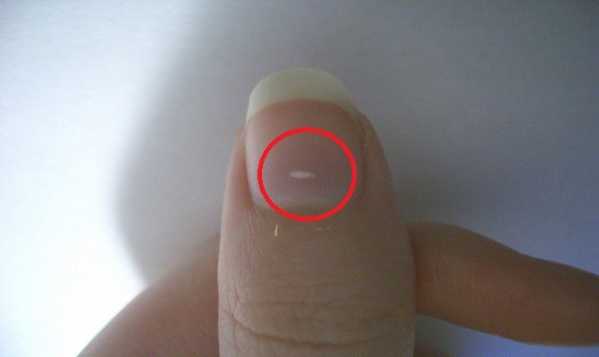 the real reason behind the white marks on nails