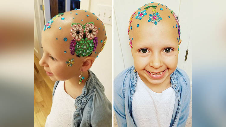 little girl suffering from alopecia