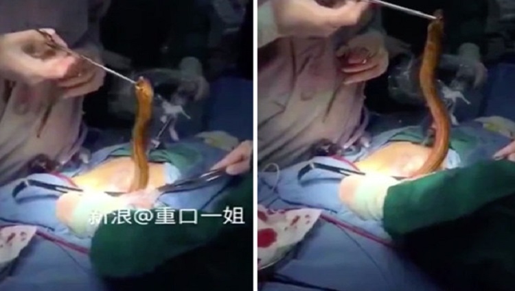 Doctor Pulls Live Eel Out Of Man Body After He Put It Up His Bum