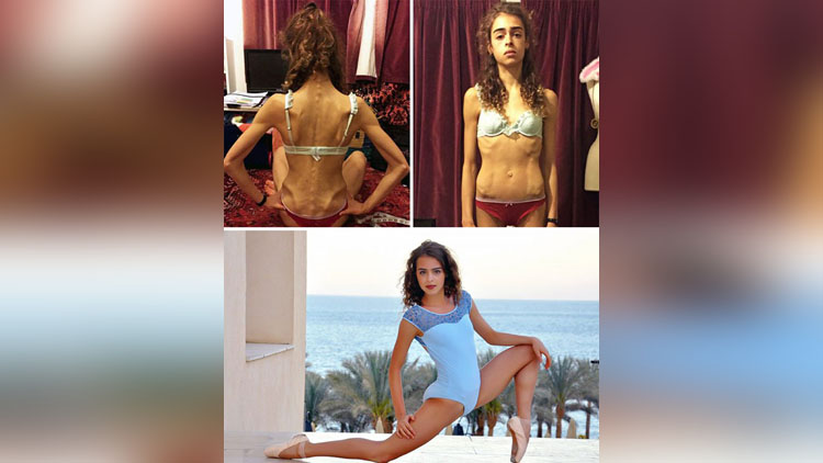 before and after pics of people who defeated anorexia 