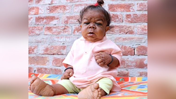Mystery condition leaves Indian man just 23 inches tall