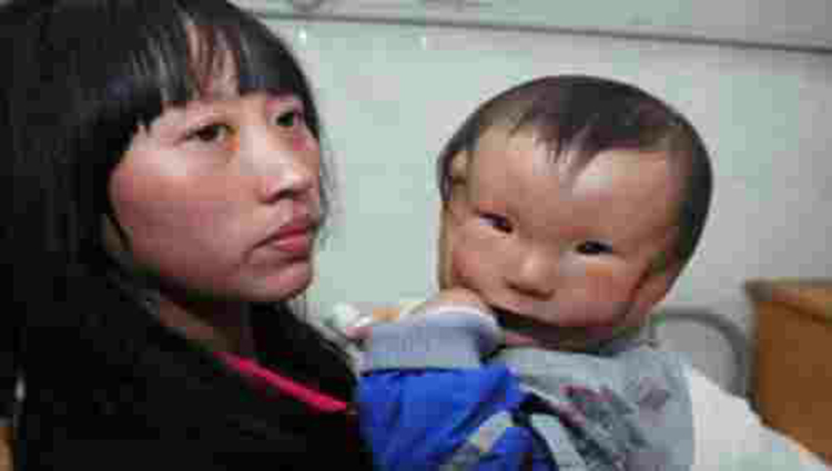 China's 'mask boy' has birth defect he appears to have two faces 