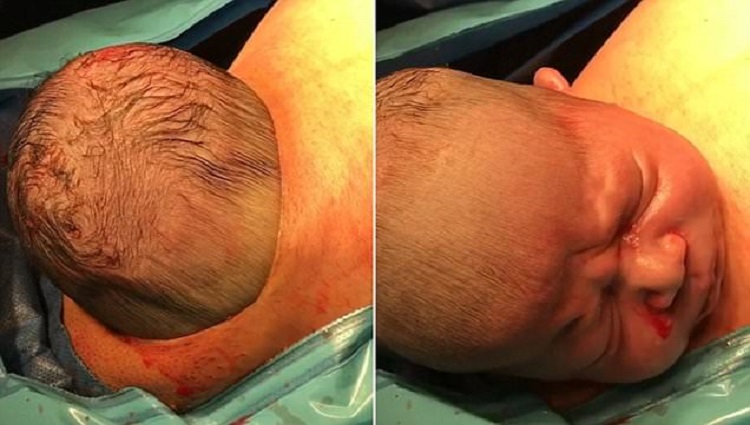 Babys head pops out of its mums stomach