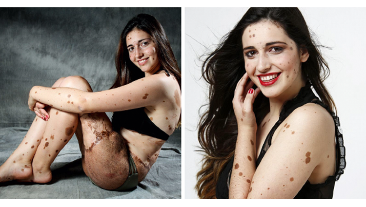 Once Bullied, Now A Modeling Sensation..Girl With 500 Birthmarks!