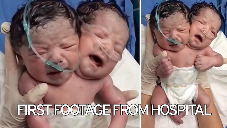 Here is the Viral Video of Baby Born with Two Heads and It is Not a Hoax! 
