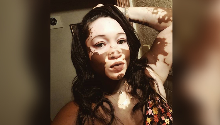 A rare skin condition model iomikoe johnson give positive message to society