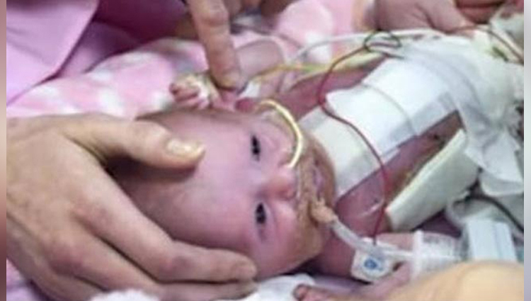 baby was born with her heart outside body and survived