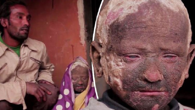 Heartbreaking: This 11-Year-Old from Nepal is Turning into Stone Due to a Rare Skin Condition! 