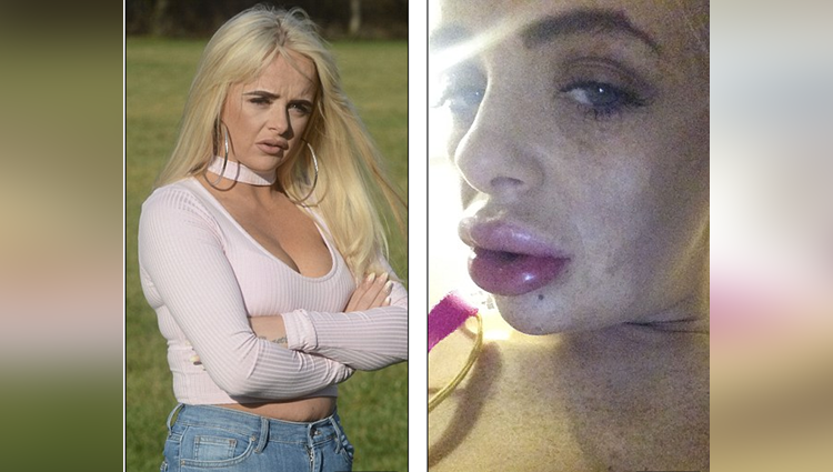 Lip filler leaves mum with lips like raw sausages