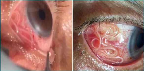 doctor removes 15 cm long parasitic worm man eye