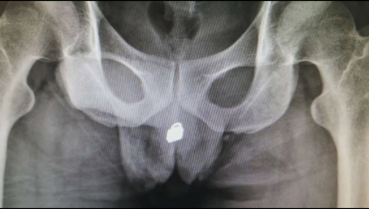 Man has a lock stuck in bladder after inserting it through his URETHRA