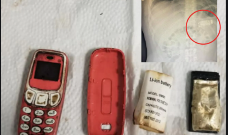 Man swallows entire Nokia 3310 mobile undergoes surgery